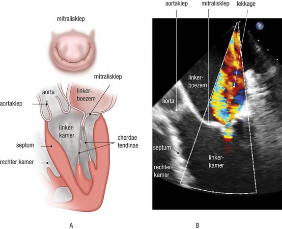 H2 4mitraliskle echo