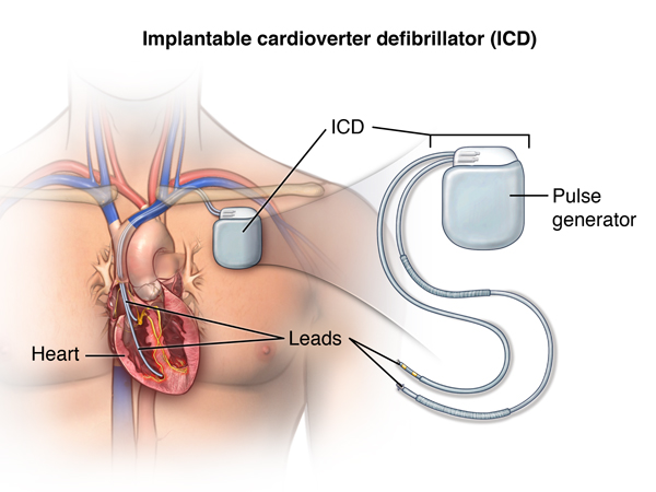 ICD implant